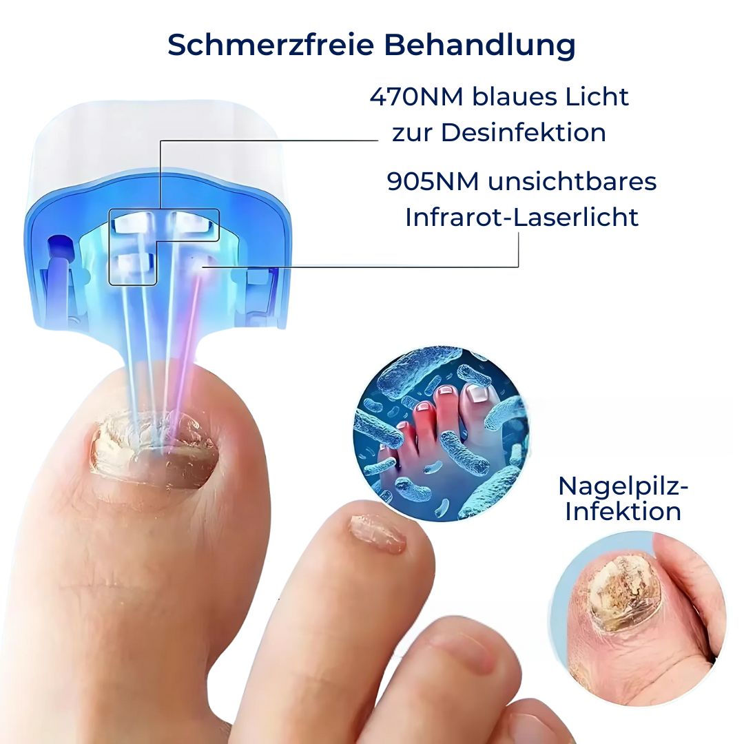 ClearNail Pro | Nail Fungus Laser Device - Painless - Effective