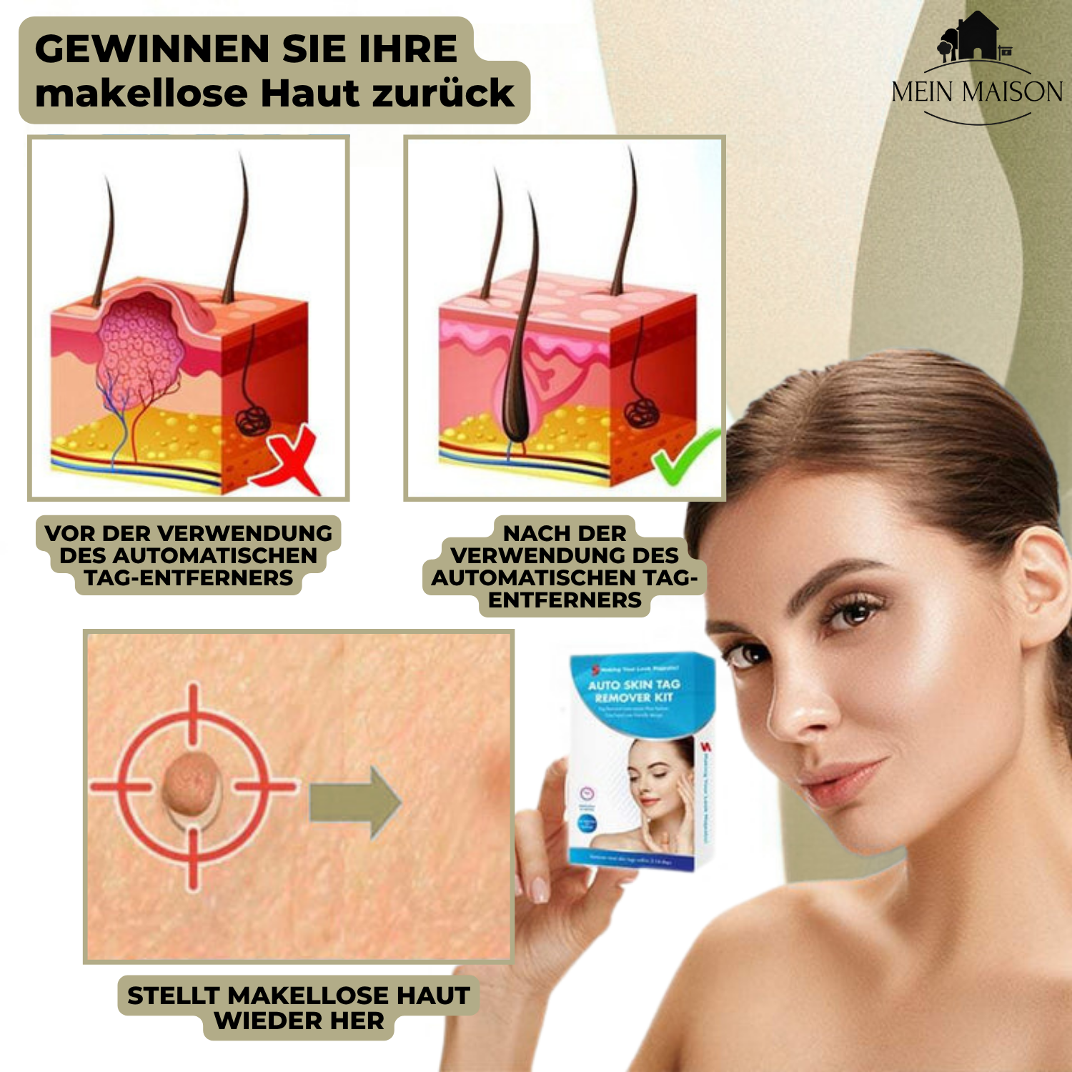 Closora | DermaLinx Wart Remover | Pain-Free Removal of Warts & Moles | For Home | Without Surgery