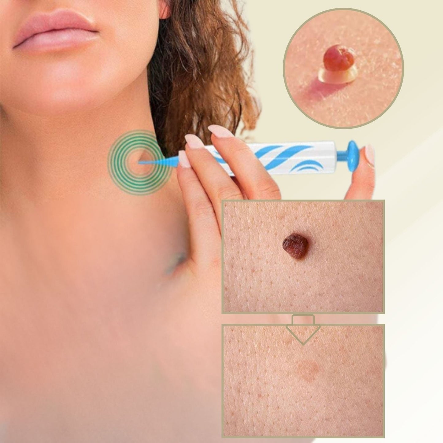 Closora | DermaLinx Wart Remover | Pain-Free Removal of Warts & Moles | For Home | Without Surgery