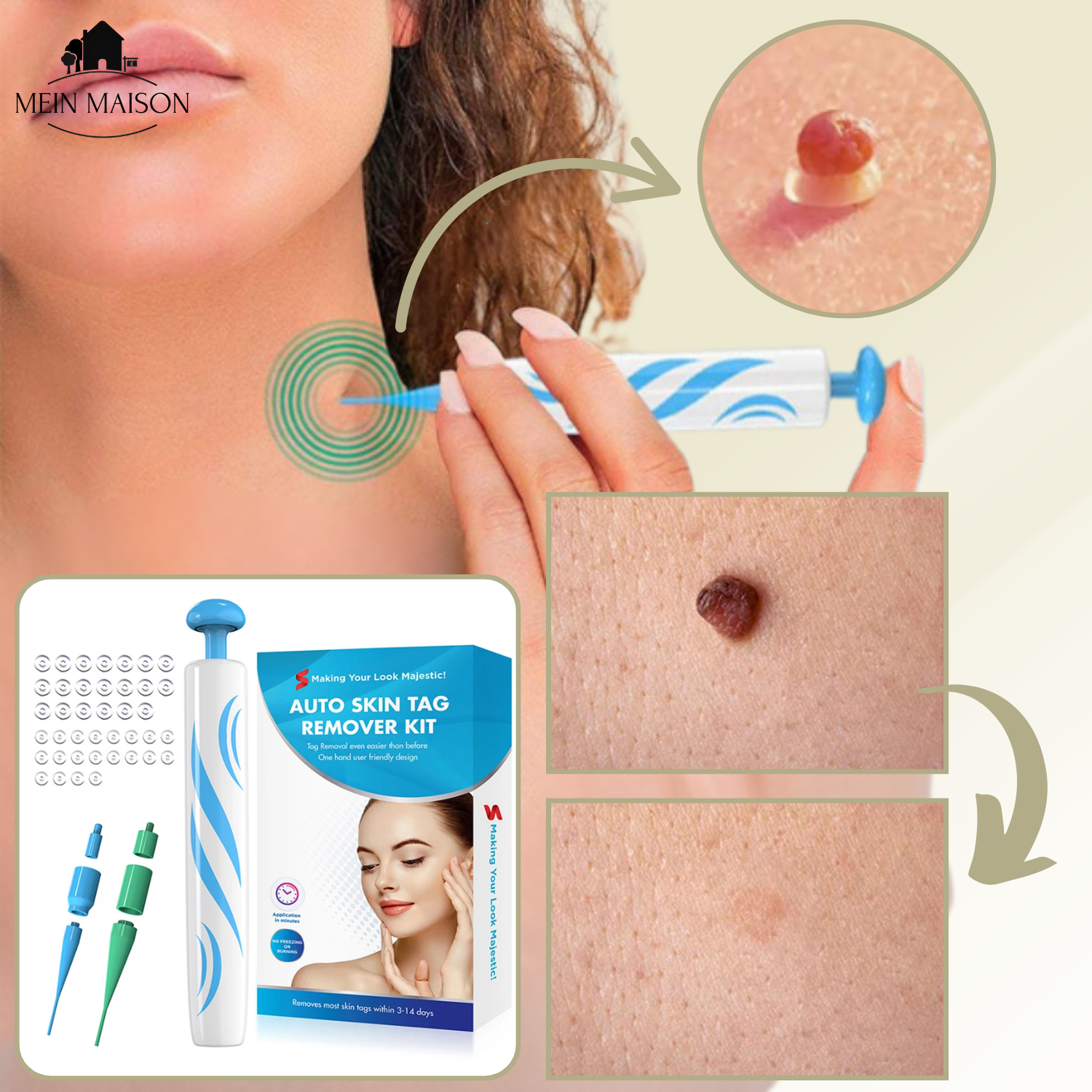 Closora | DermaLinx Wart Remover | Pain-Free Removal of Warts & Moles | For Home | Without Surgery