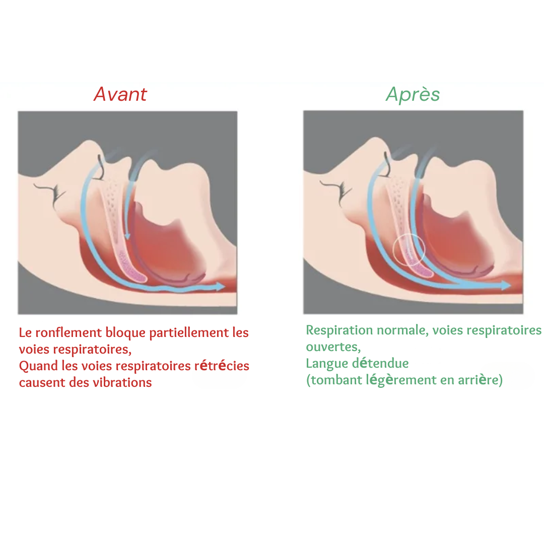 Premium Anti-Snoring Orthosis: Comfortable Sleep Mouthpiece