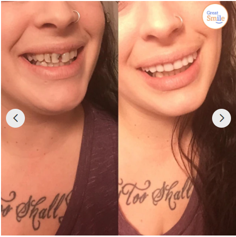 Removable Tooth Set | Perfect Smile
