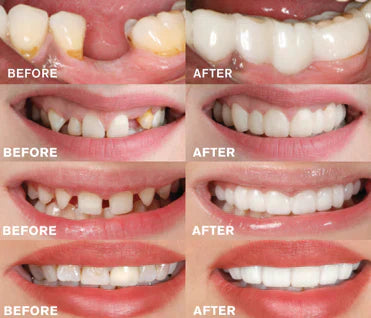 Removable Tooth Set | Perfect Smile