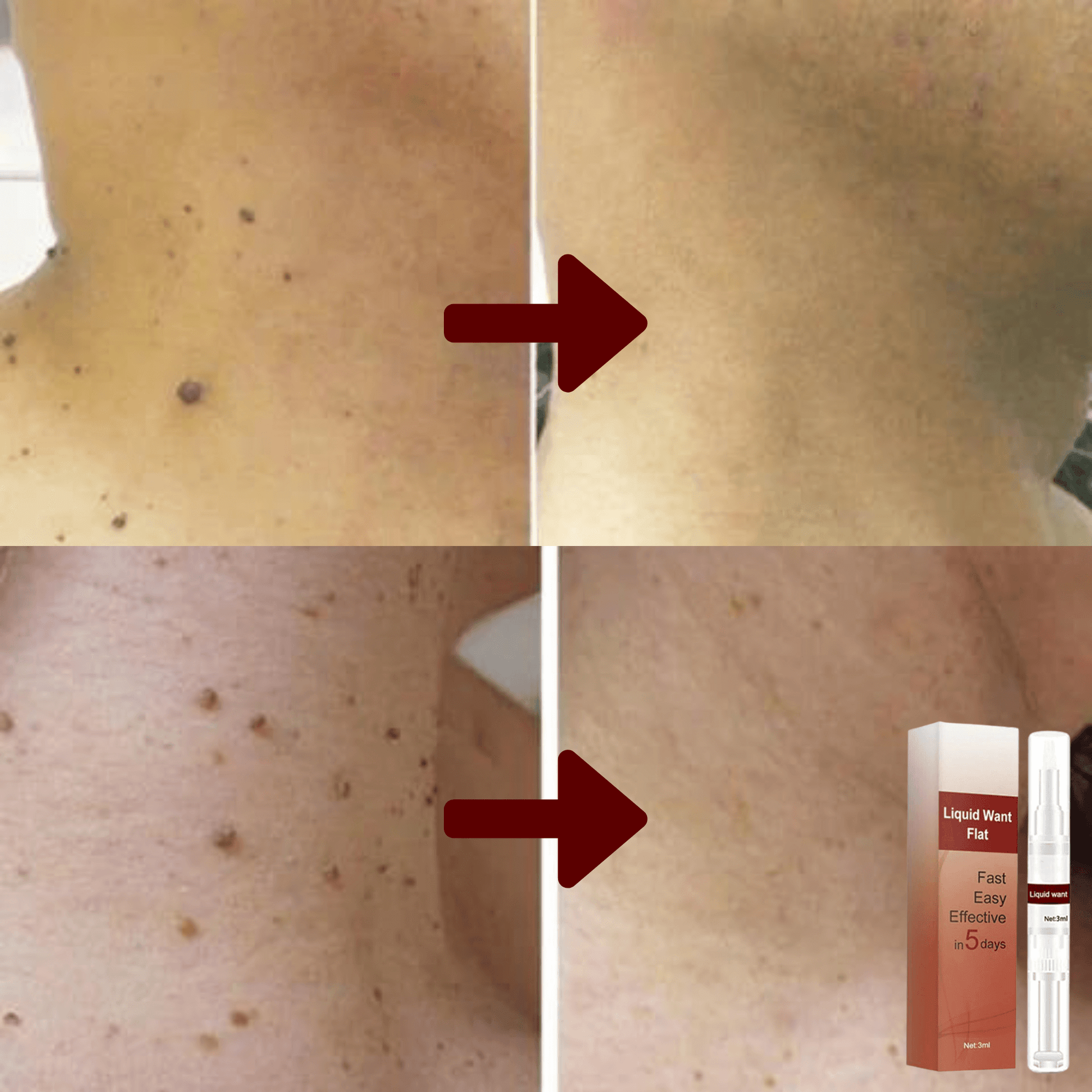 Skin Tag Remover