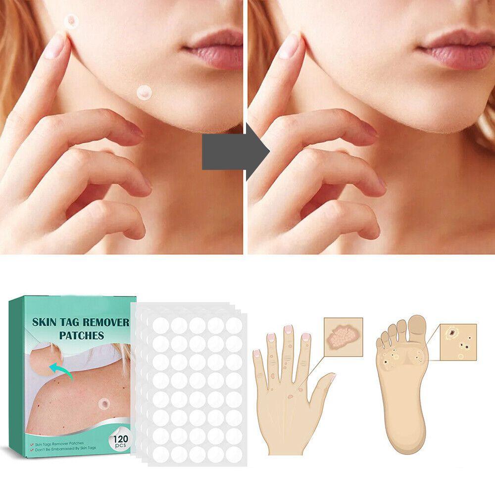 SkinClear - Patch for the removal of spots and warts Closora