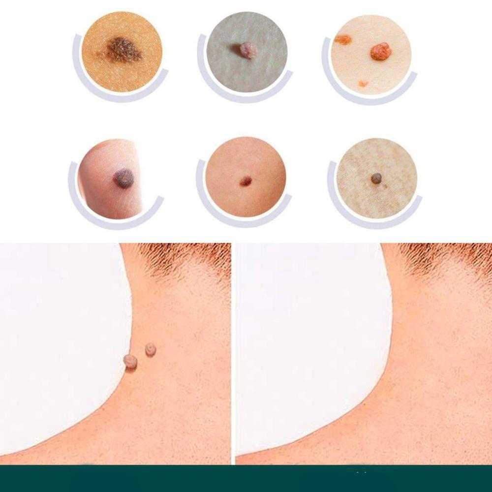 SkinClear - Patch for the removal of spots and warts Closora