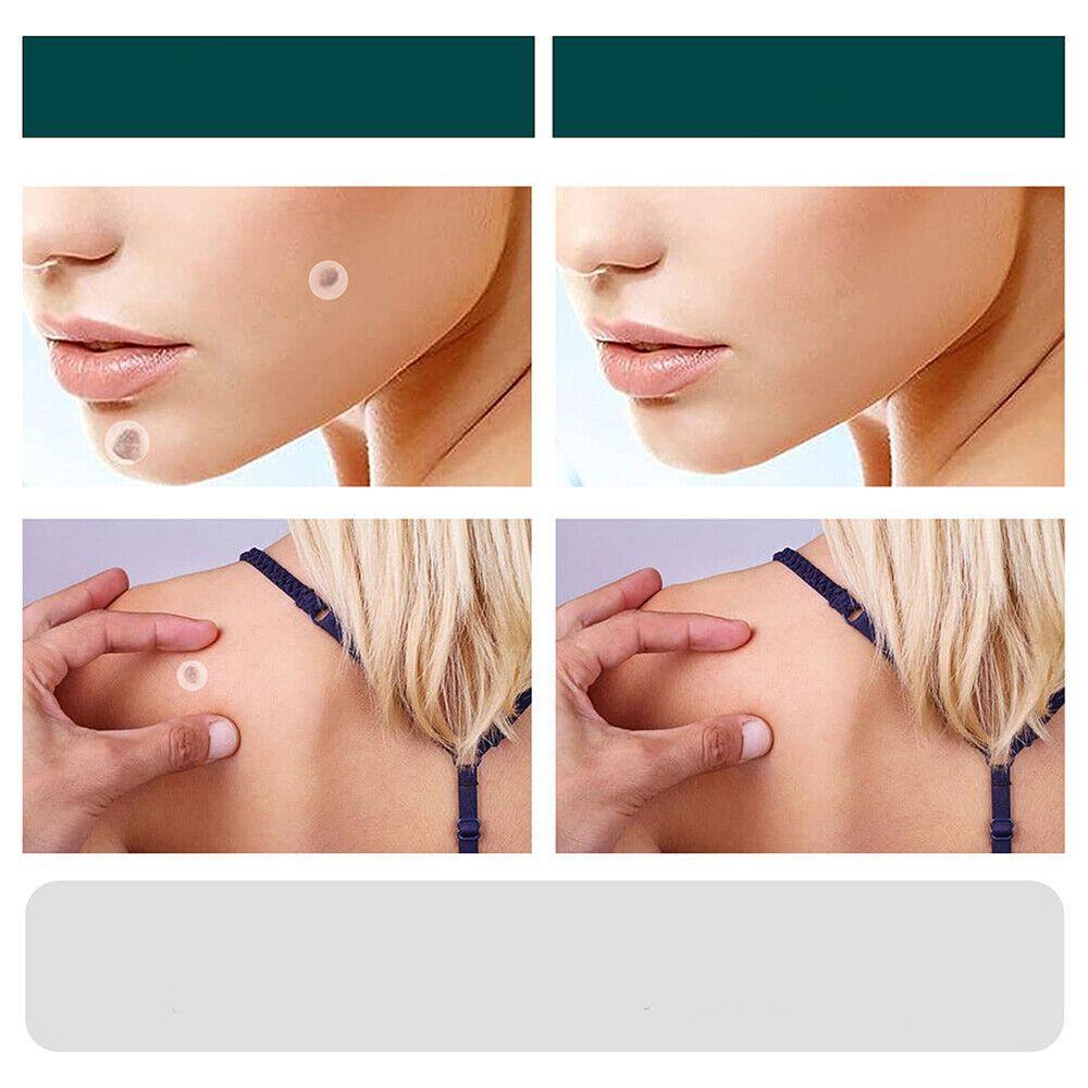SkinClear - Patch for the removal of spots and warts Closora