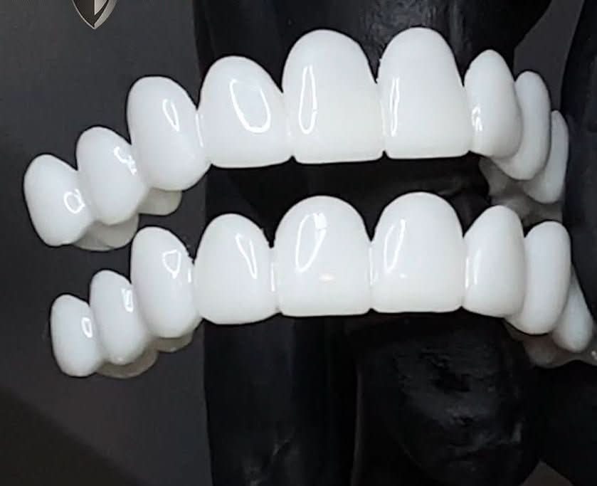 SmileFlex Dental Prosthesis with White Veneers