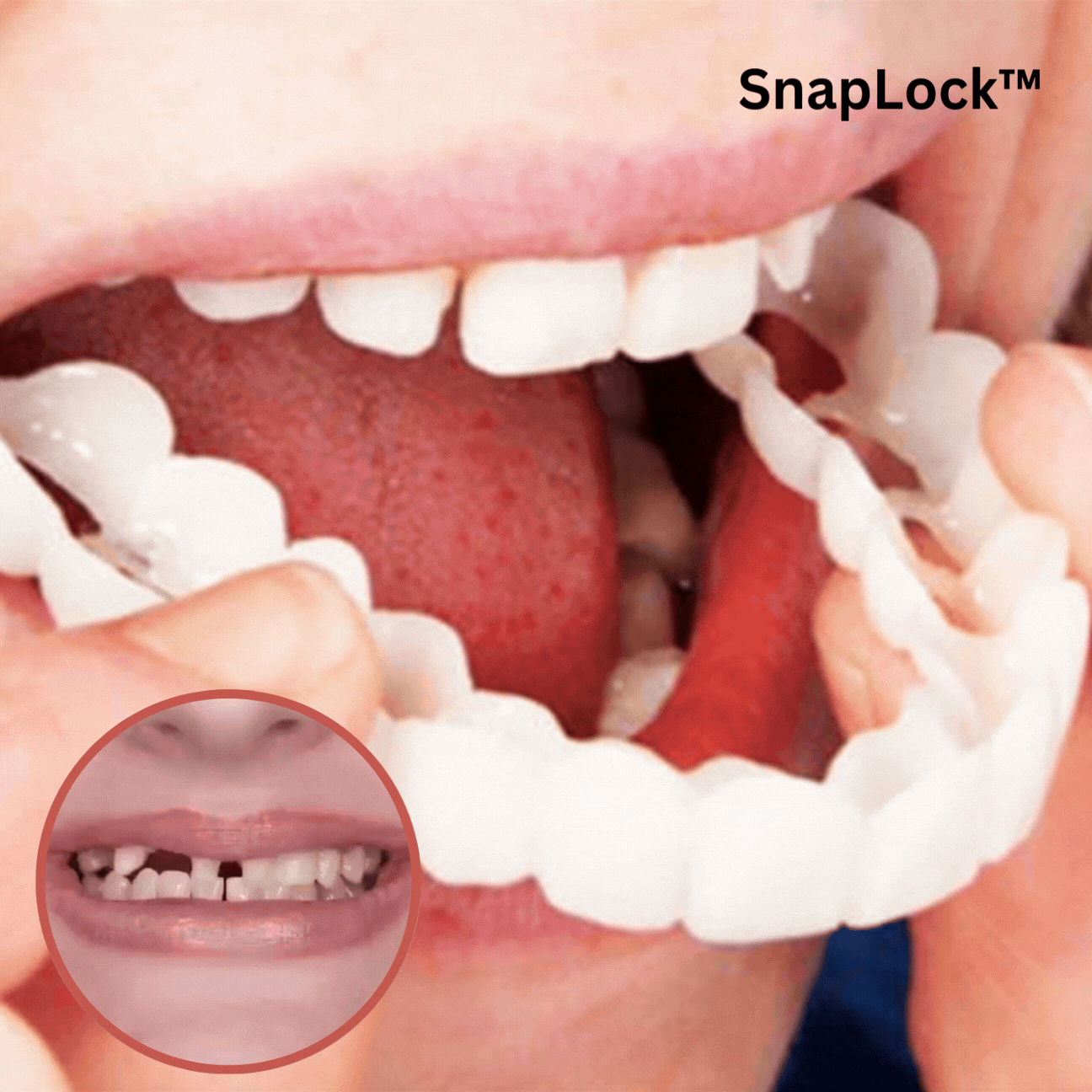 Snap-On Denture - Perfect Smile