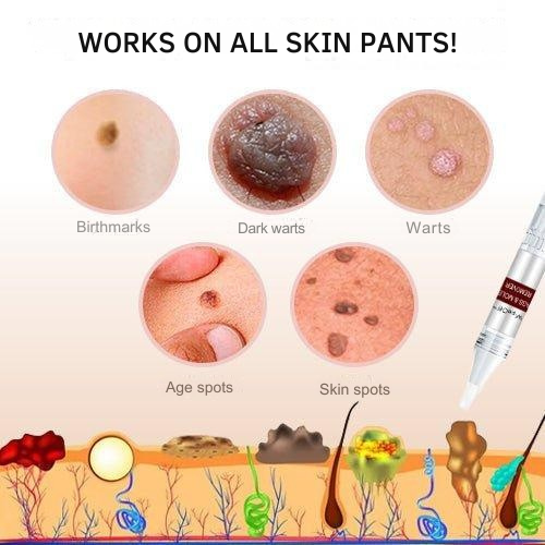 Wart Remover | Precision Applicator for Spot Treatment | Plant-Based Care Formula | WartOff
