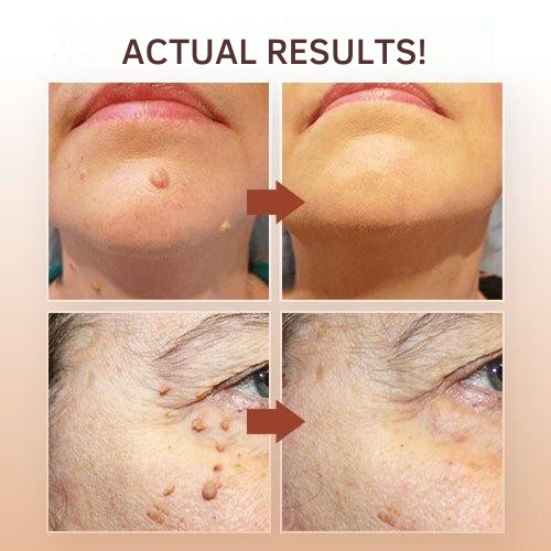 Wart Remover | Precision Applicator for Spot Treatment | Plant-Based Care Formula | WartOff