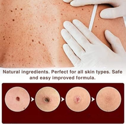 Wart Remover | Precision Applicator for Spot Treatment | Plant-Based Care Formula | WartOff